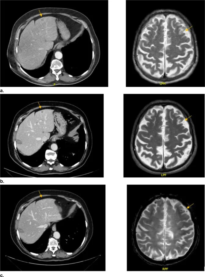 A patient, who was diagnosed with Stage IV Lung Adenocarcinoma