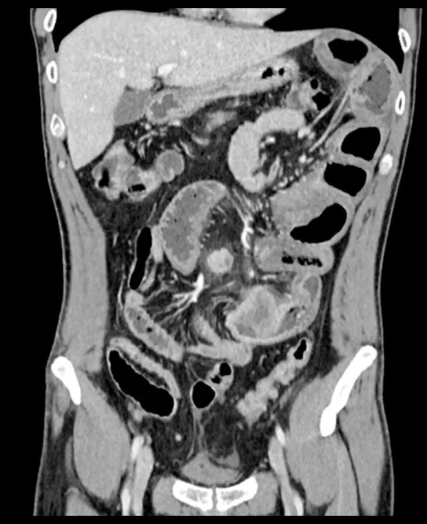 A patient, who was diagnosed with Stage IV Lung Adenocarcinoma