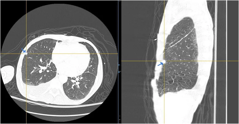 A patient, who was diagnosed with Lung Adenocarcinoma