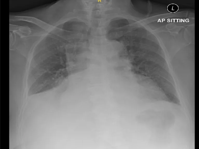 A patient, who was diagnosed with Stage IV Lung Adenocarcinoma
