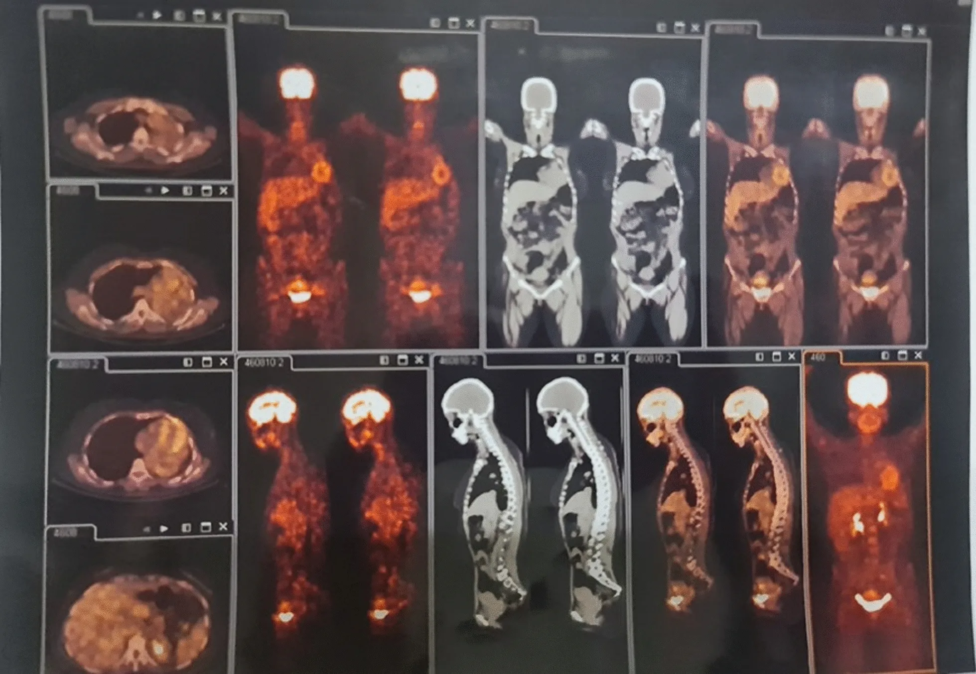 A patient, who was diagnosed with Stage III Lung Adenocarcinoma