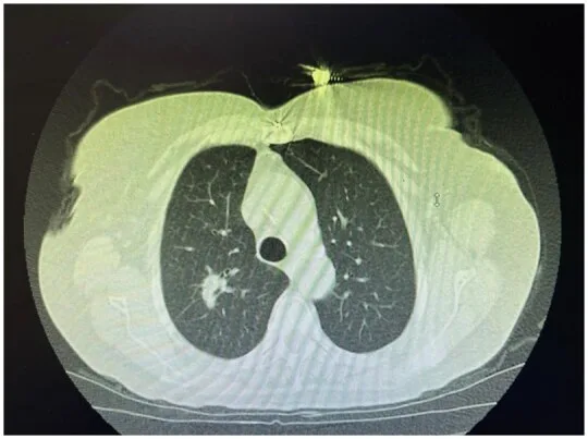 A patient, who was diagnosed with Stage I Lung Adenocarcinoma