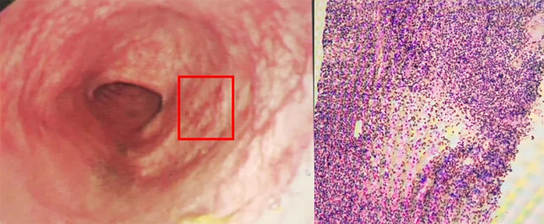 A patient, who was diagnosed with Stage II Invasive Ductal Carcinoma