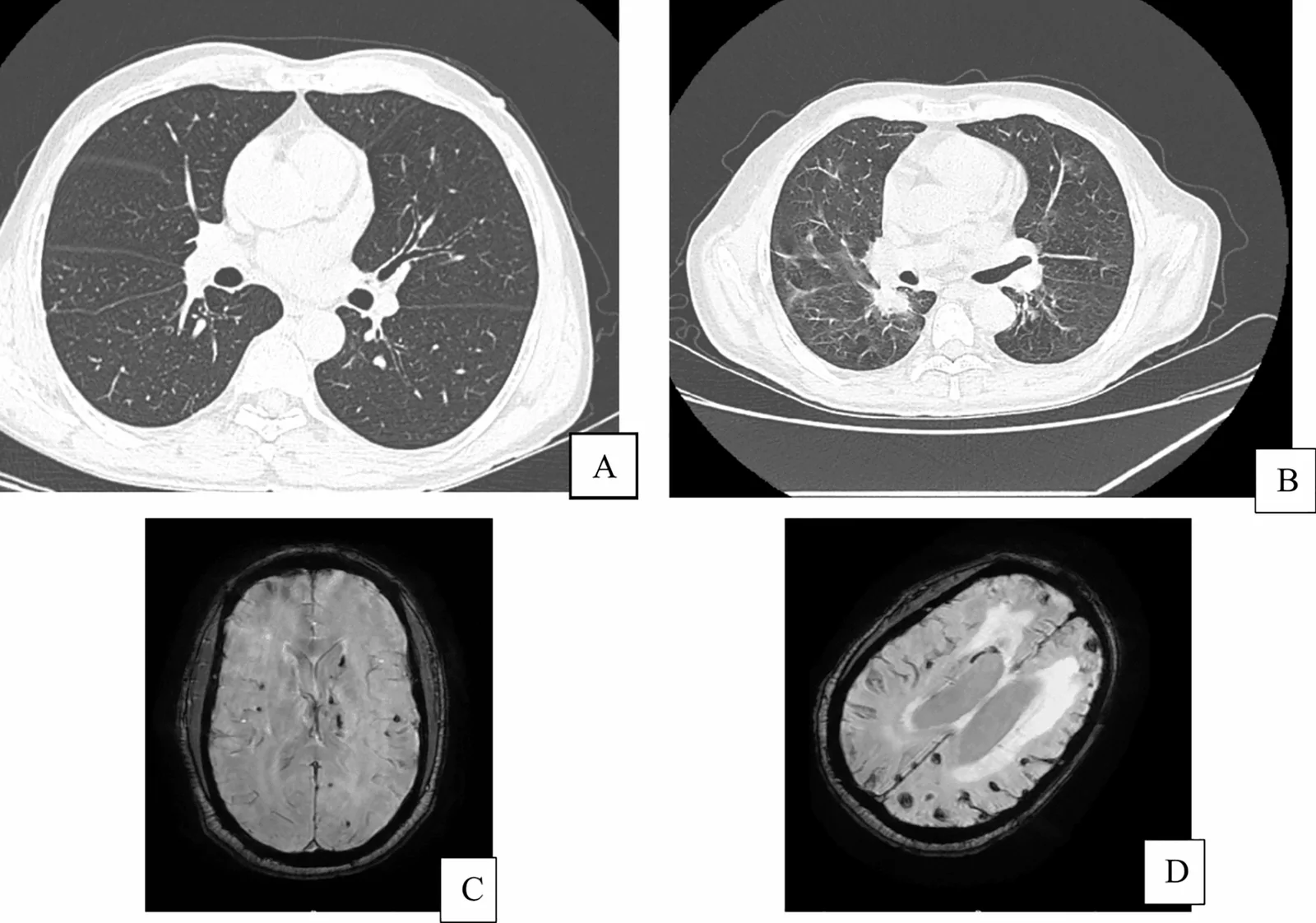 A patient, who was diagnosed with Stage IV Lung Adenocarcinoma