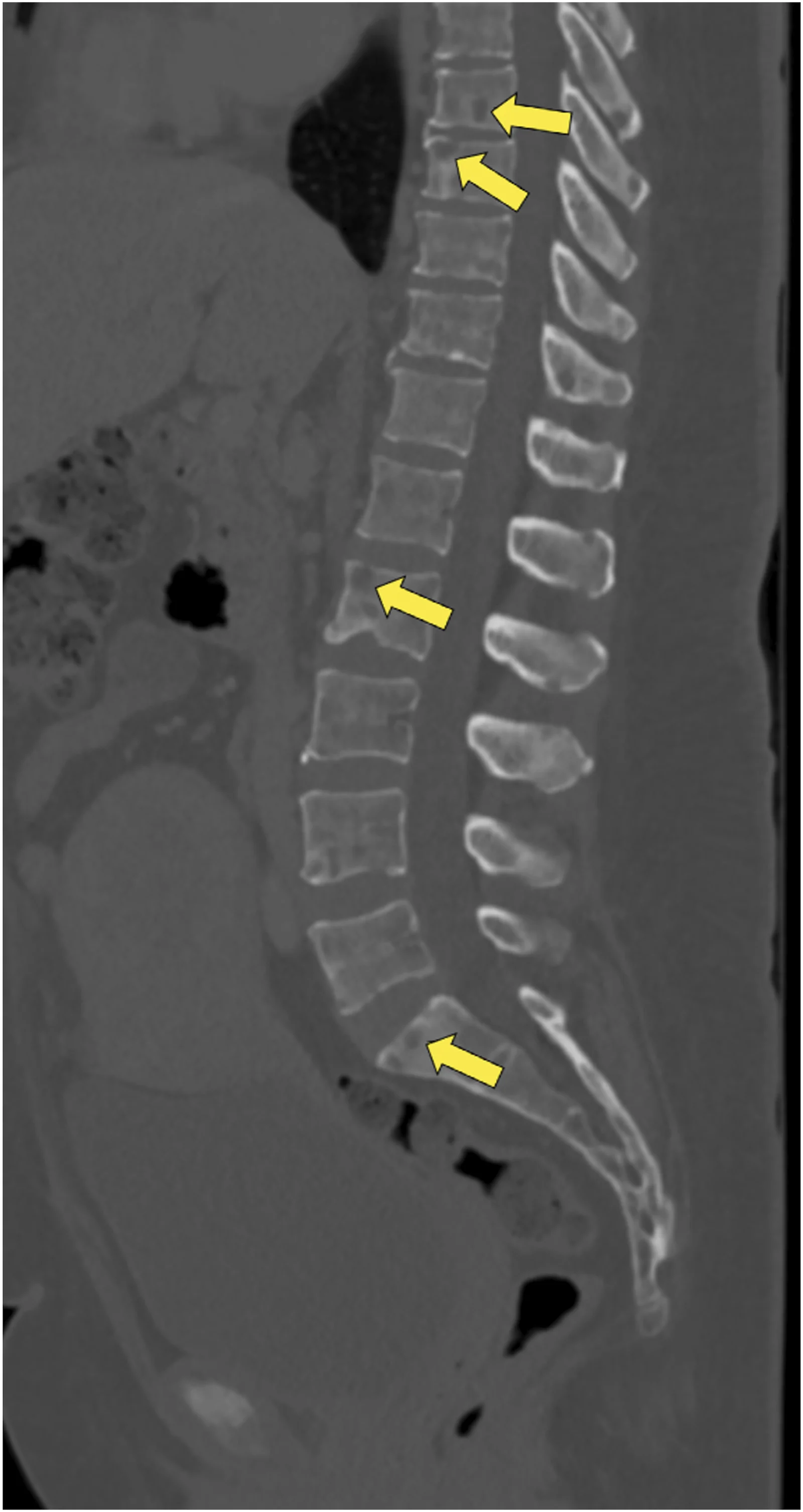 A patient, who was diagnosed with Stage IV Invasive Ductal Carcinoma