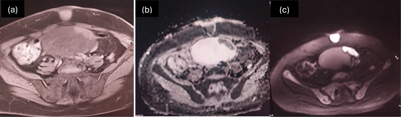 A patient, who was diagnosed with Stage IV Ovarian Adenocarcinoma