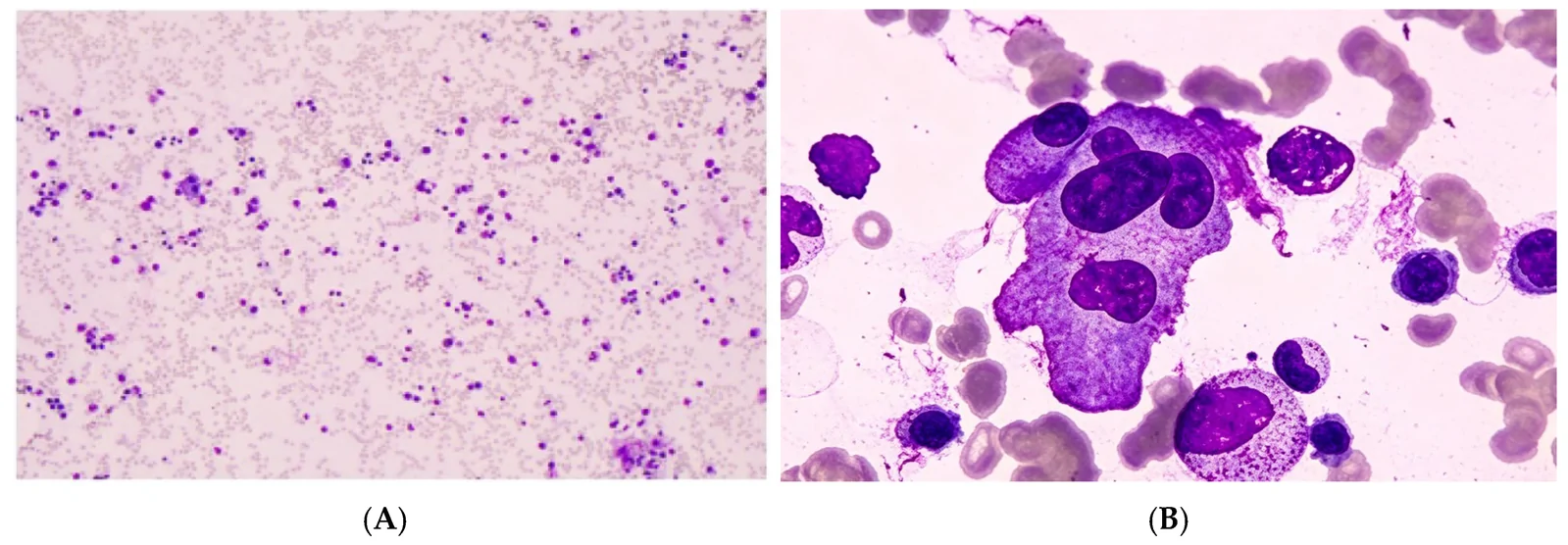 A patient, who was diagnosed with Stage II Breast Cancer