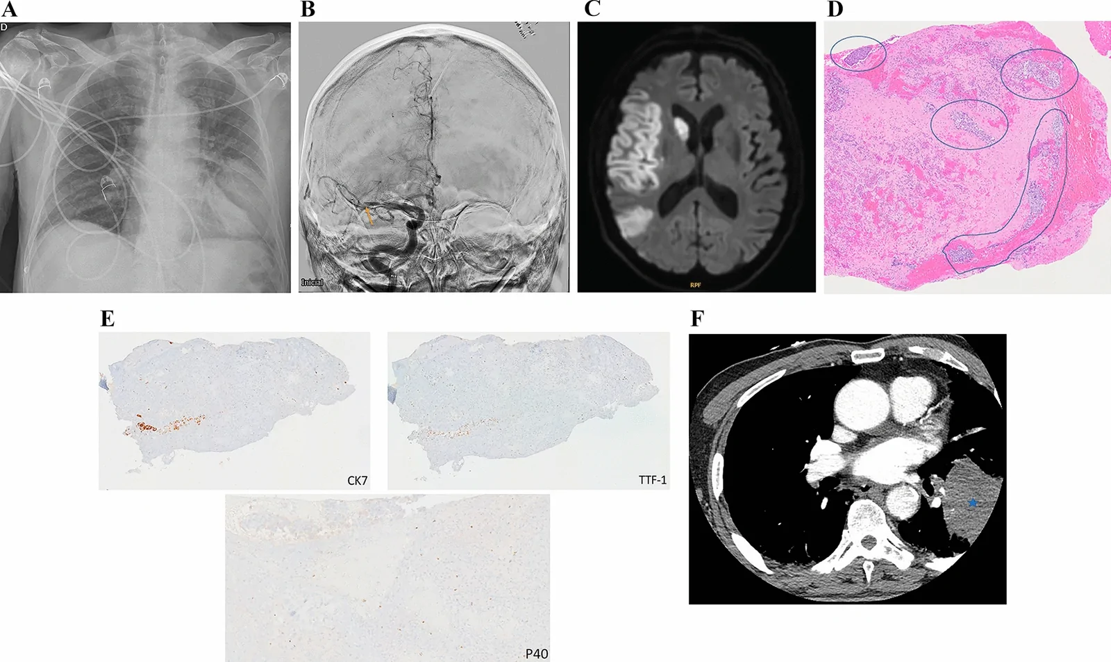 A patient, who was diagnosed with Stage IV Lung Adenocarcinoma