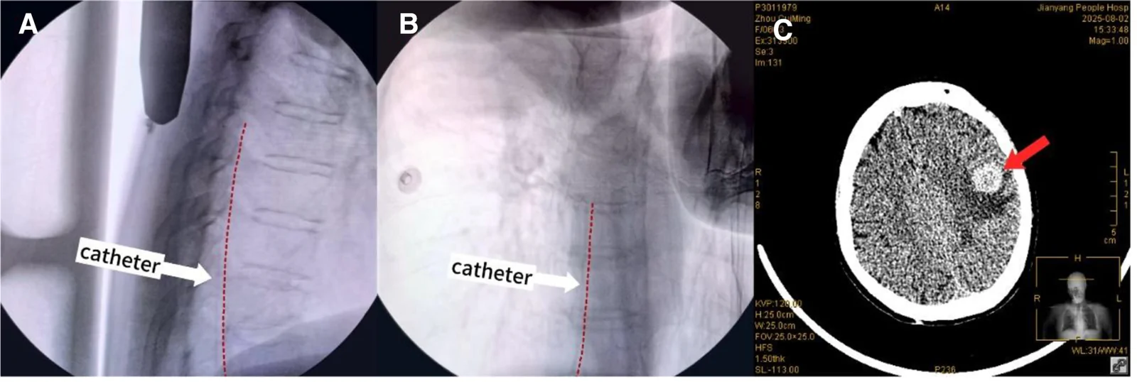 A patient, who was diagnosed with Stage IV Colorectal Cancer
