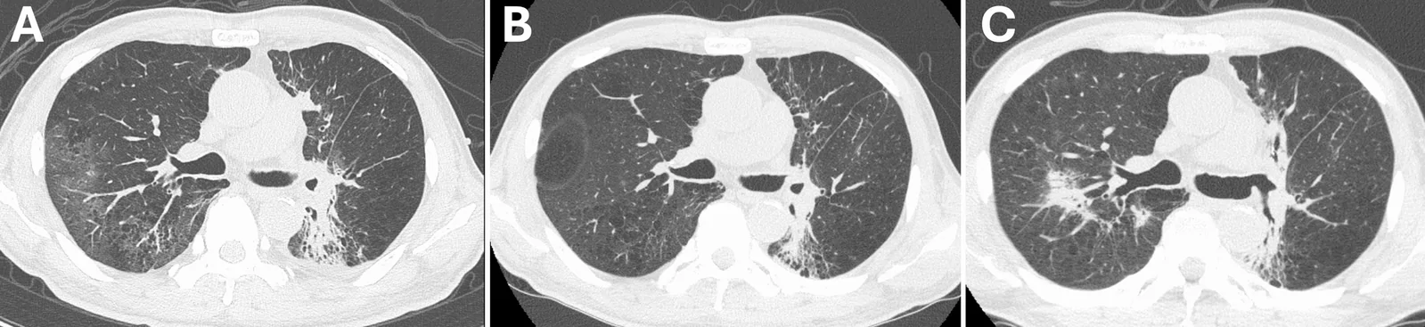 A patient, who was diagnosed with Non-Small Cell Lung Cancer