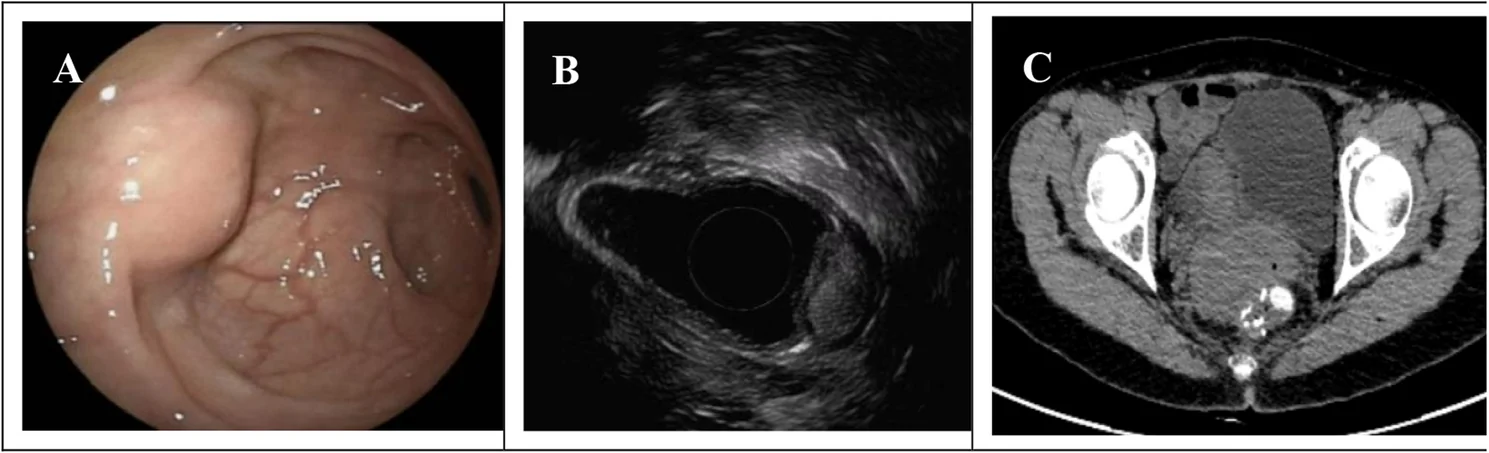 A patient, who was diagnosed with Colorectal Cancer