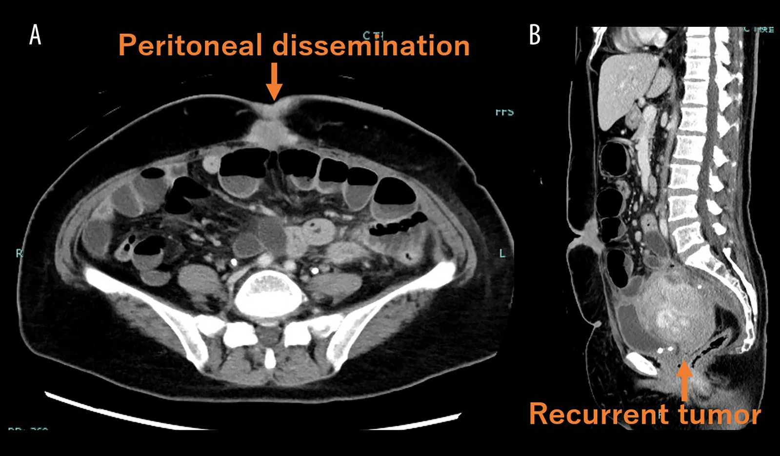 A patient, who was diagnosed with Stage IV Colorectal Cancer