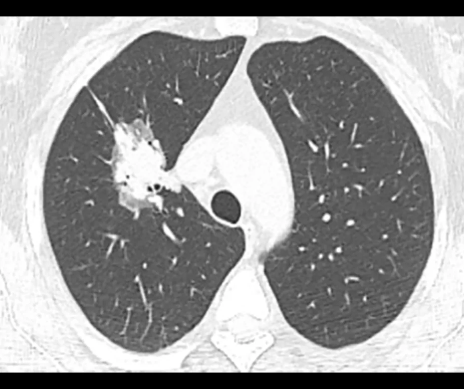 A patient, who was diagnosed with Stage IV Lung Adenocarcinoma