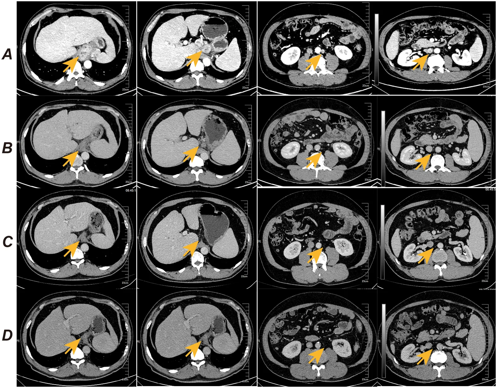 A patient, who was diagnosed with Stage IV Gastric Adenocarcinoma