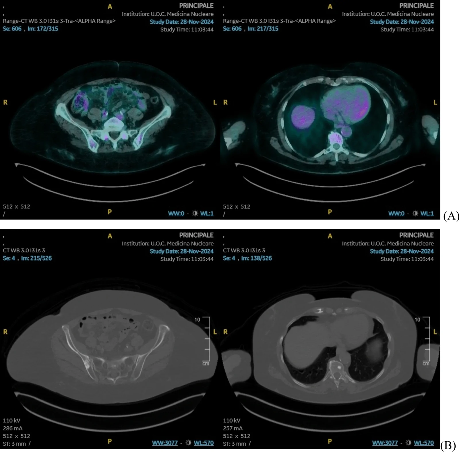 A patient, who was diagnosed with Stage IV Breast Cancer