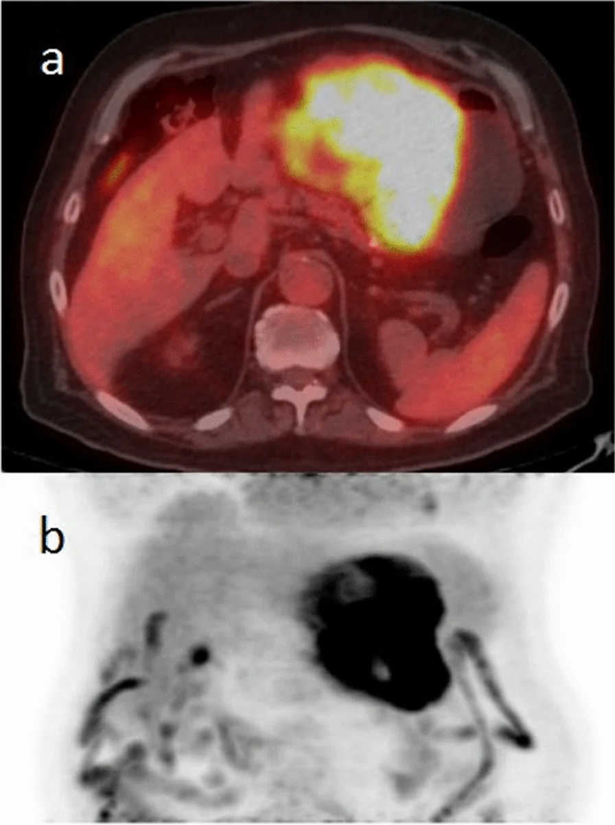 A patient, who was diagnosed with Stage IV Gastric Adenocarcinoma