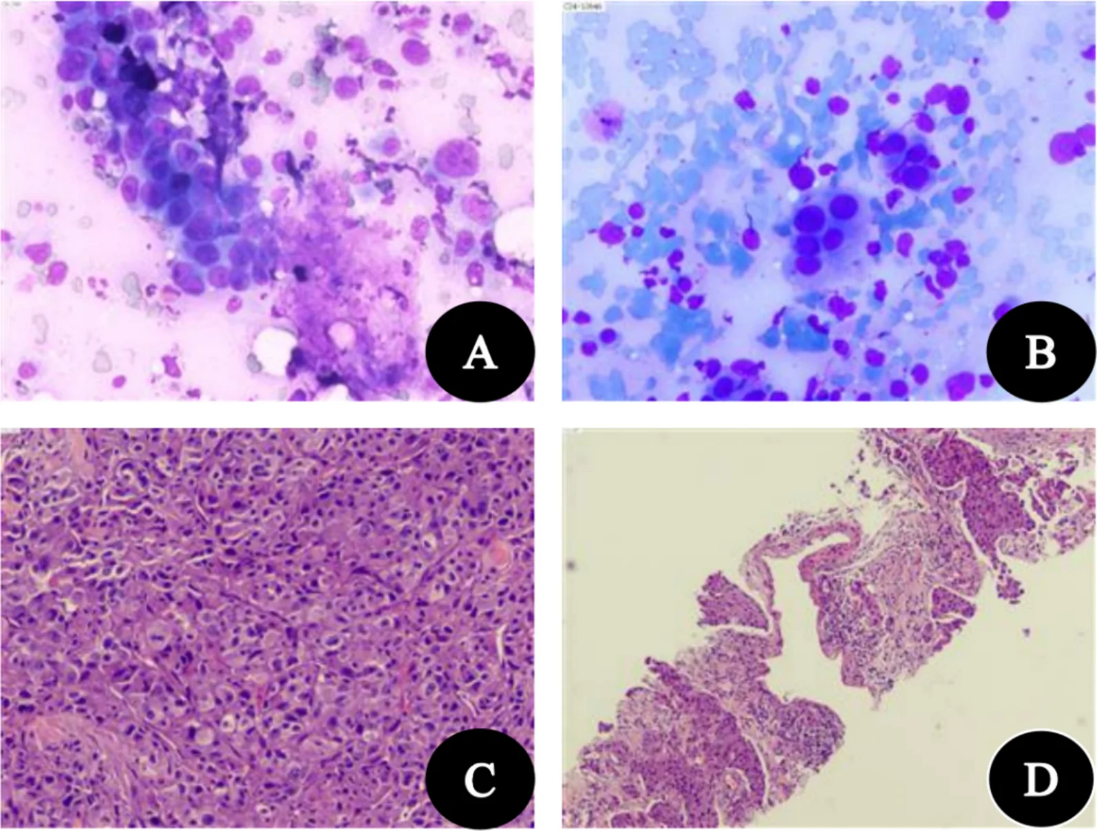 A patient, who was diagnosed with Stage IV Lung Adenocarcinoma