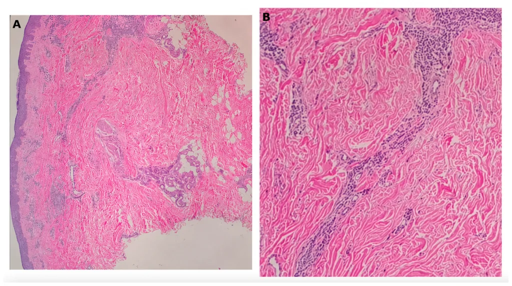 A patient, who was diagnosed with Invasive Lobular Carcinoma