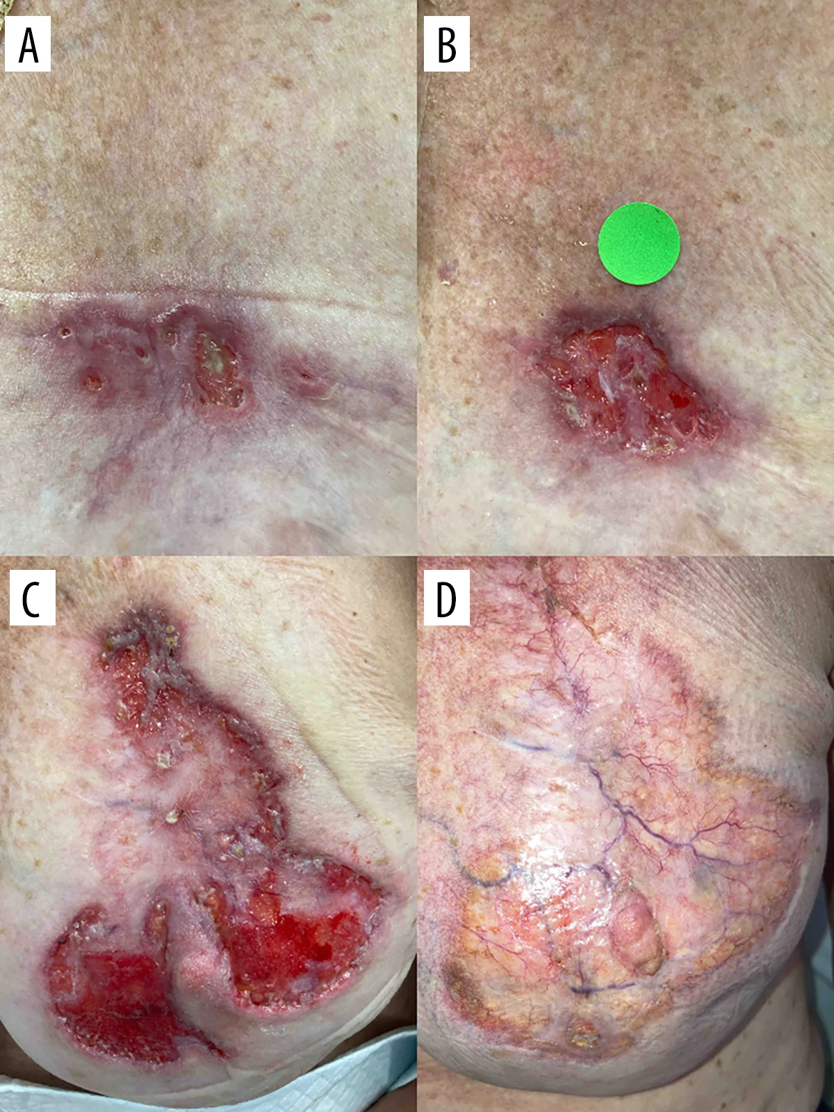 A patient, who was diagnosed with Breast Cancer