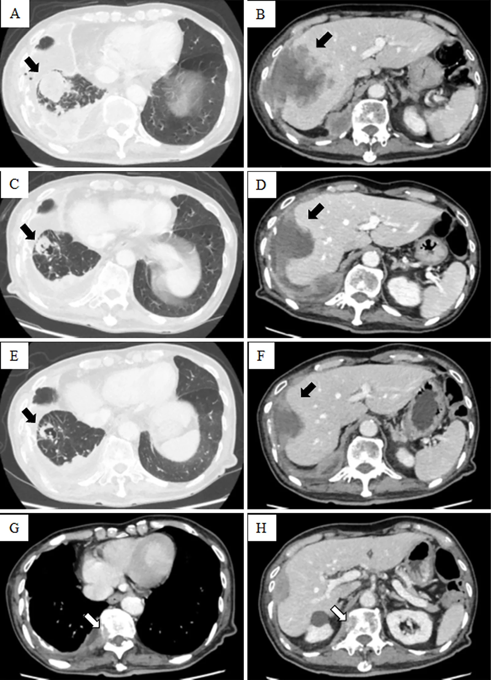 A patient, who was diagnosed with Stage IV Lung Squamous Cell Carcinoma