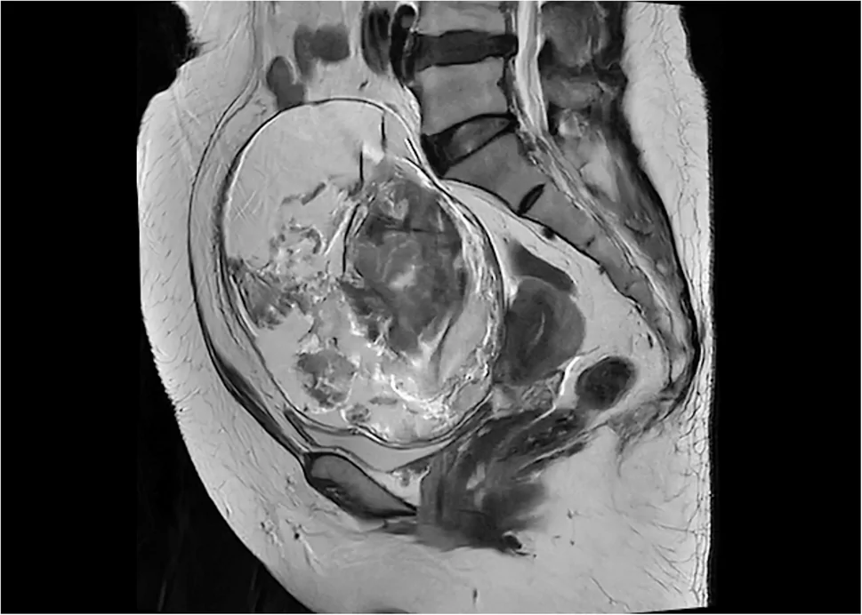 A patient, who was diagnosed with Stage I Ovarian Squamous Cell Carcinoma