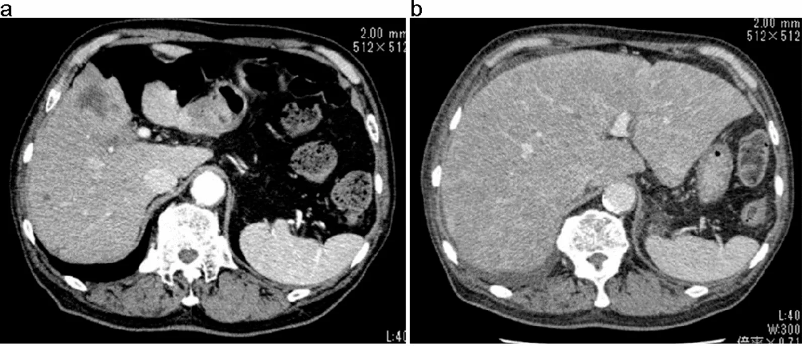 A patient, who was diagnosed with Stage IV Small Cell Lung Cancer