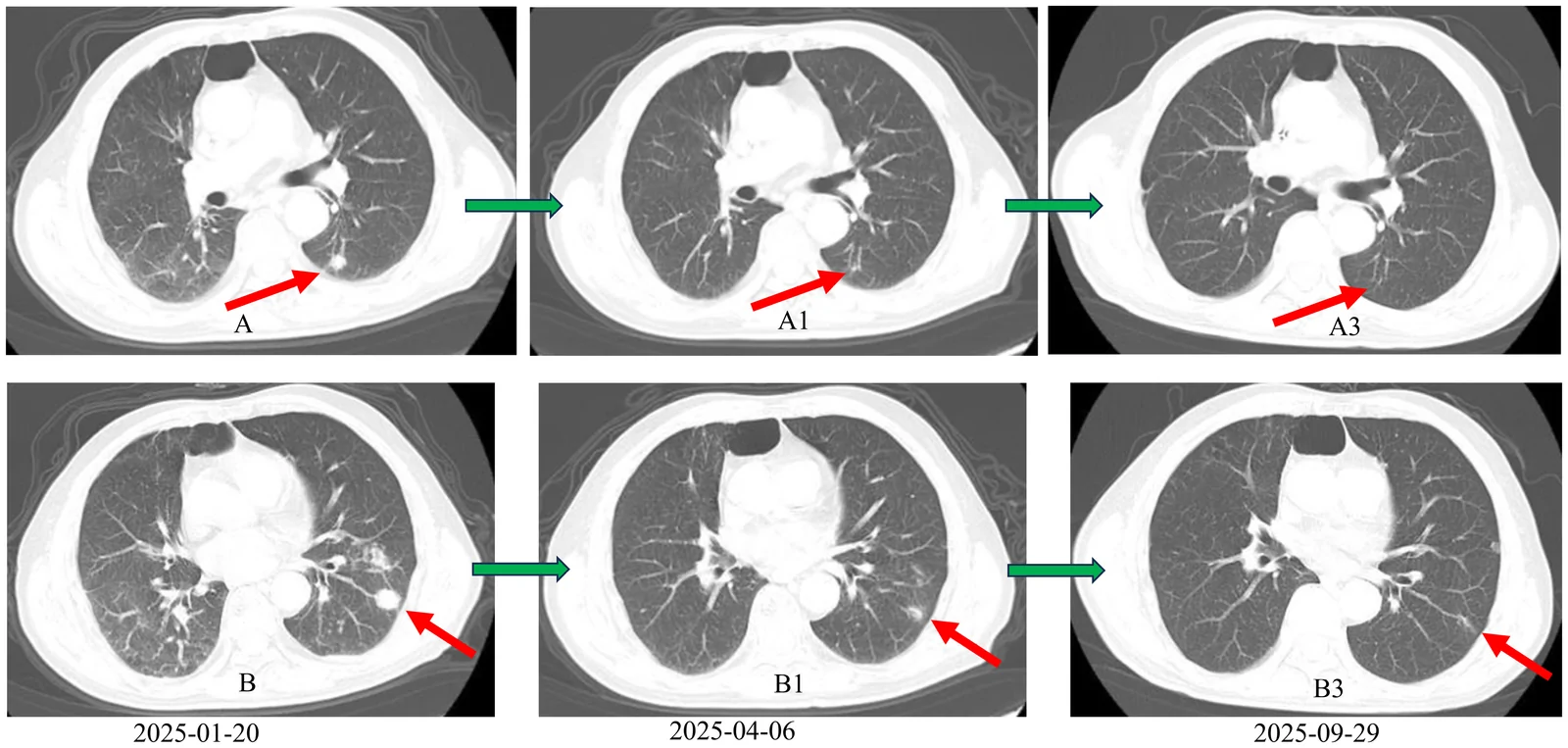 A patient, who was diagnosed with Stage IV Colorectal Adenocarcinoma