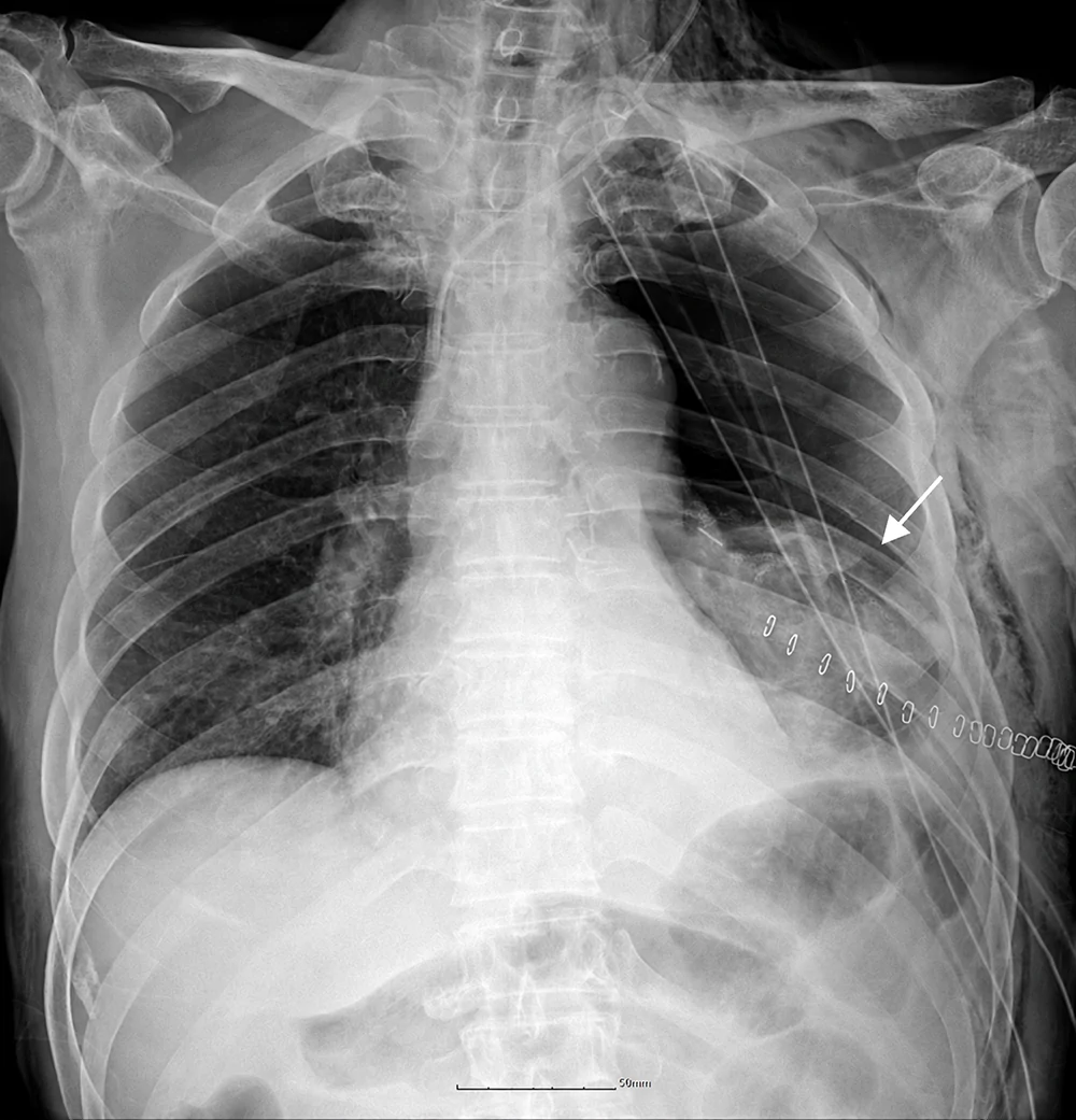 A patient, who was diagnosed with Lung Adenocarcinoma