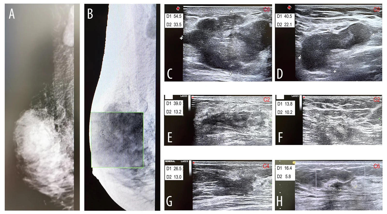 A patient, who was diagnosed with Stage III Invasive Ductal Carcinoma