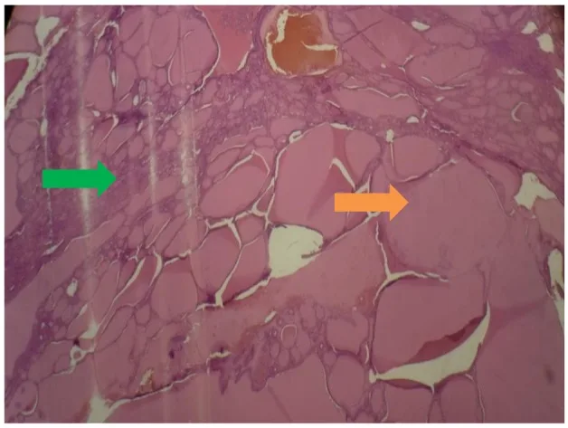 A patient, who was diagnosed with Ovarian Cancer