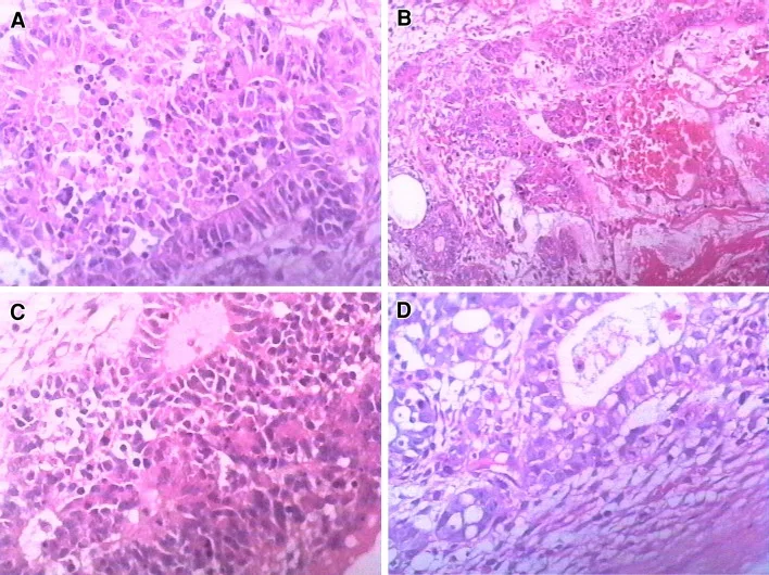 A patient, who was diagnosed with Stage I Ovarian Cancer