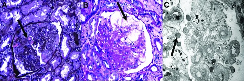 A patient, who was diagnosed with Stage III Ovarian Cancer