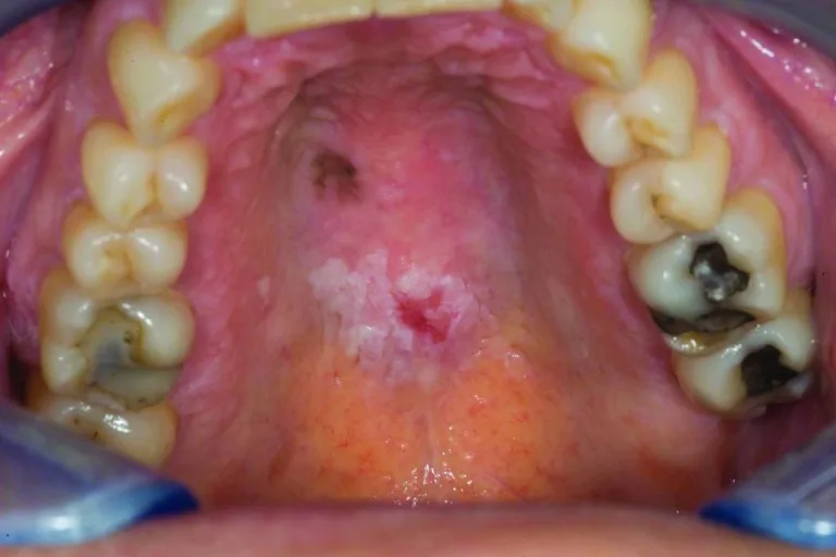 A patient, who was diagnosed with Stage III Ovarian Cancer