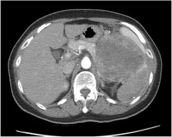 A patient, who was diagnosed with Ovarian Cancer