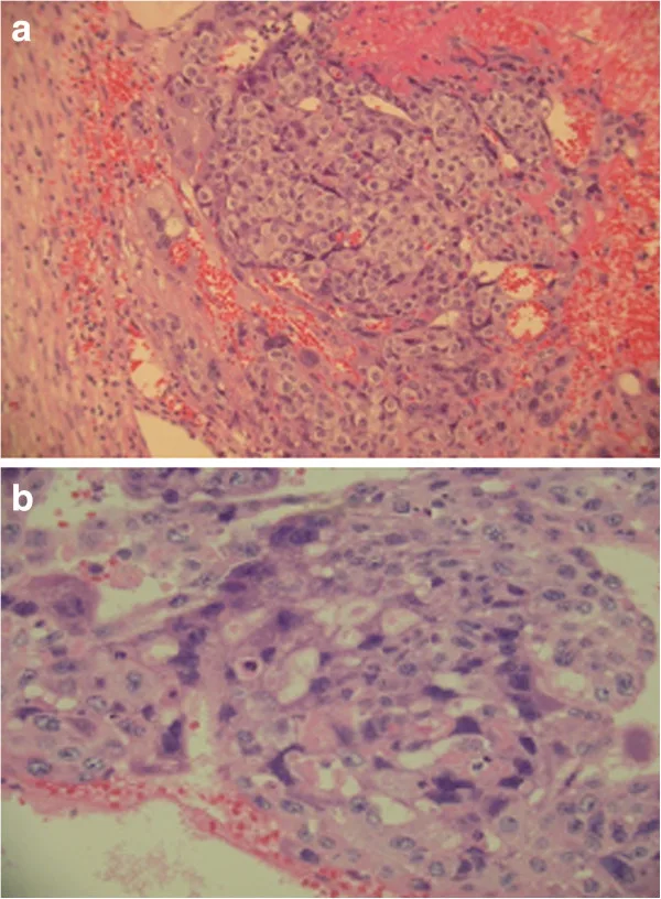 A patient, who was diagnosed with Ovarian Cancer