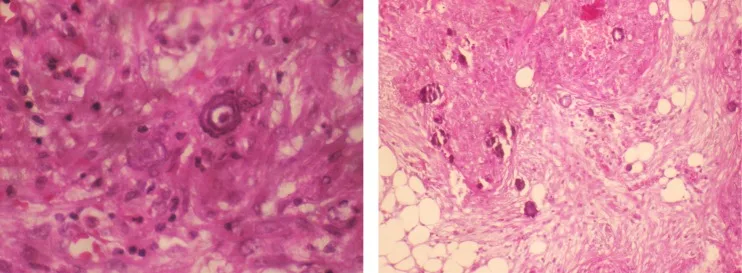 A patient, who was diagnosed with Stage III Ovarian Cancer