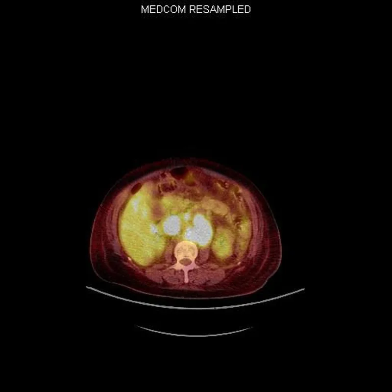 A patient, who was diagnosed with Stage IV Ovarian Cancer