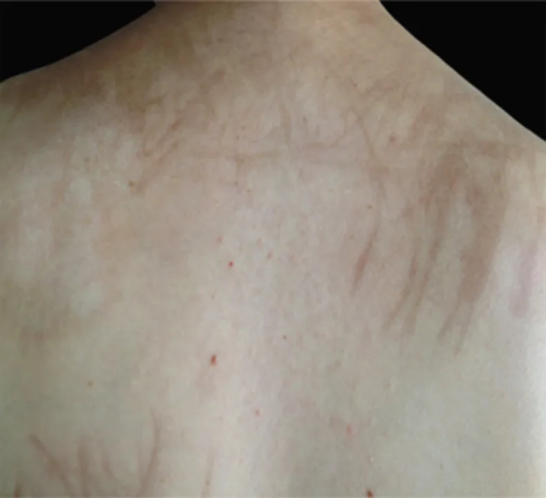 A patient, who was diagnosed with Ovarian Cancer