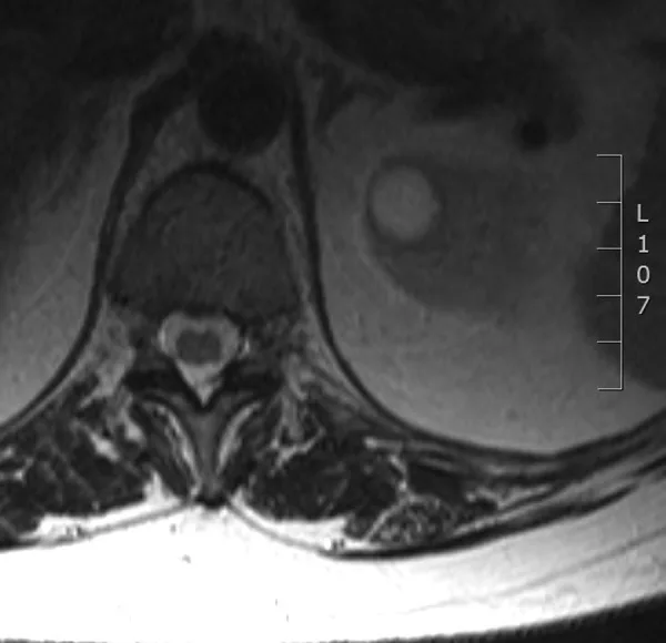 A patient, who was diagnosed with Stage IV Ovarian Cancer