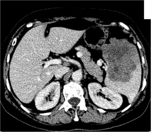 A patient, who was diagnosed with Stage IV Ovarian Cancer
