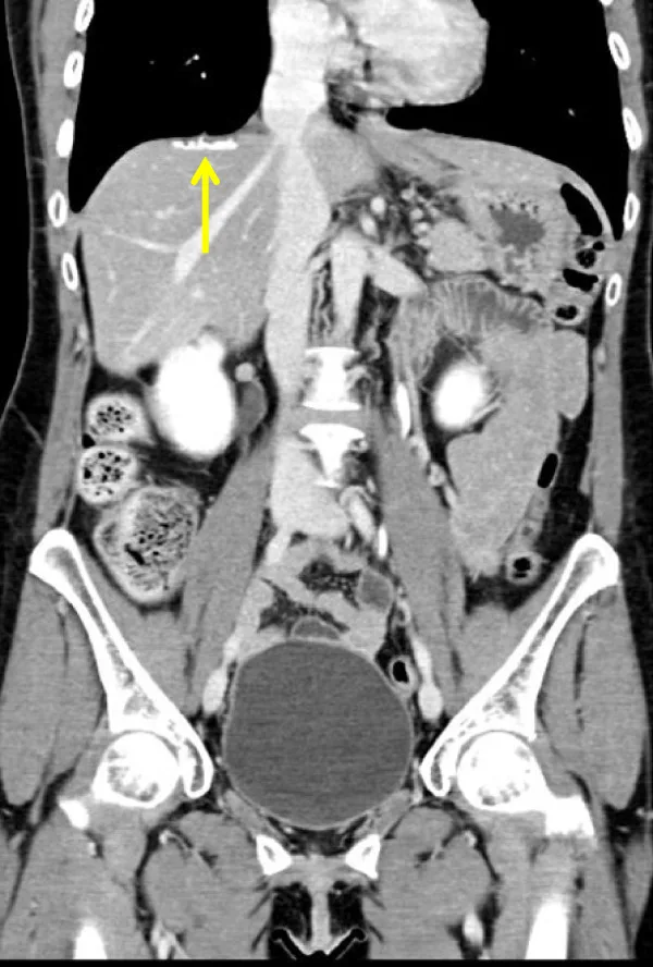 A patient, who was diagnosed with Stage III Ovarian Cancer