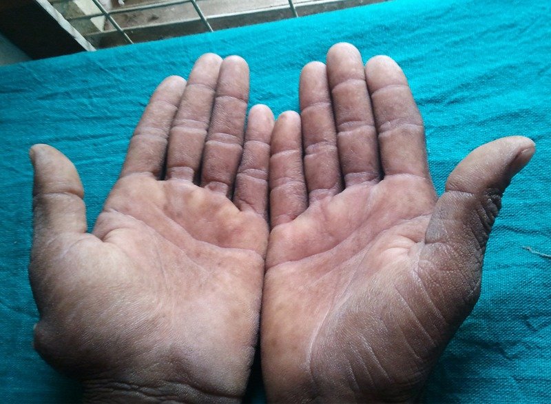 A patient, who was diagnosed with Gastric Adenocarcinoma