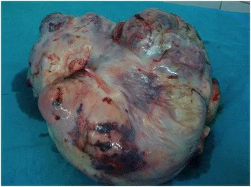 A patient, who was diagnosed with Ovarian Cancer