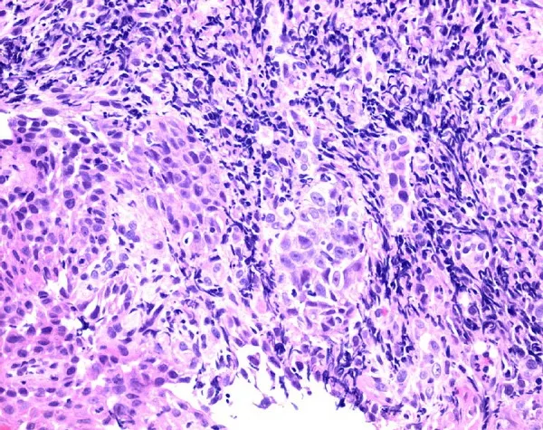 A patient, who was diagnosed with Stage III Ovarian Cancer