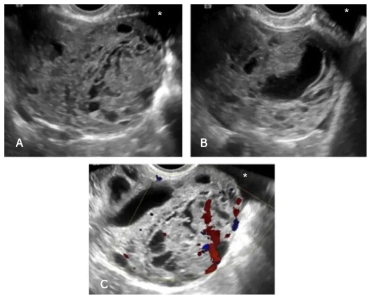 A patient, who was diagnosed with Stage I Ovarian Cancer