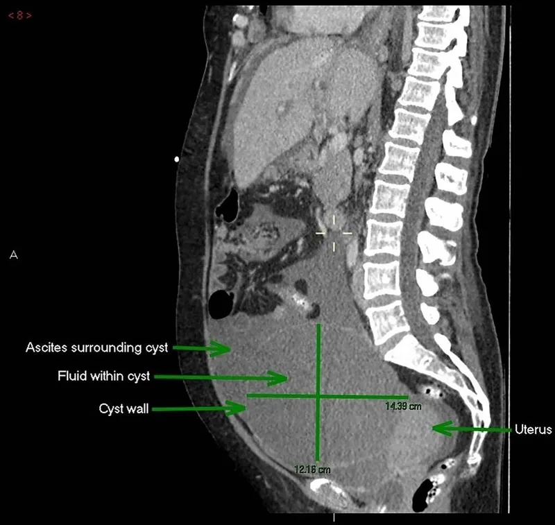 A patient, who was diagnosed with Stage III Ovarian Cancer