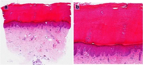 A patient, who was diagnosed with Ovarian Cancer