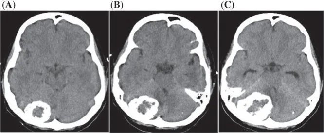 A patient, who was diagnosed with Stage IV Ovarian Adenocarcinoma