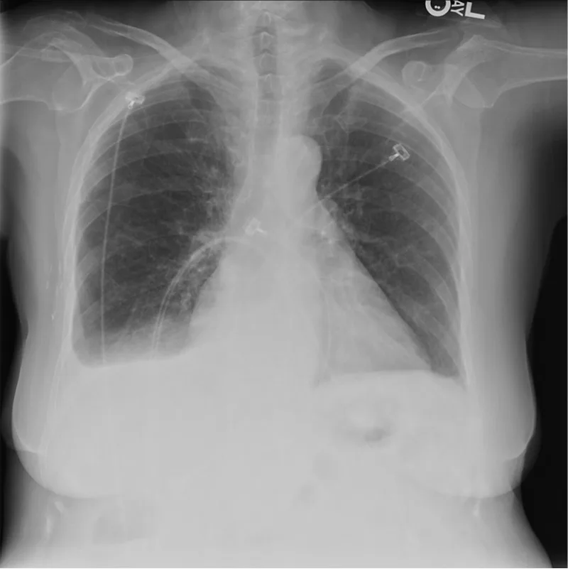A patient, who was diagnosed with Stage IV Ovarian Cancer