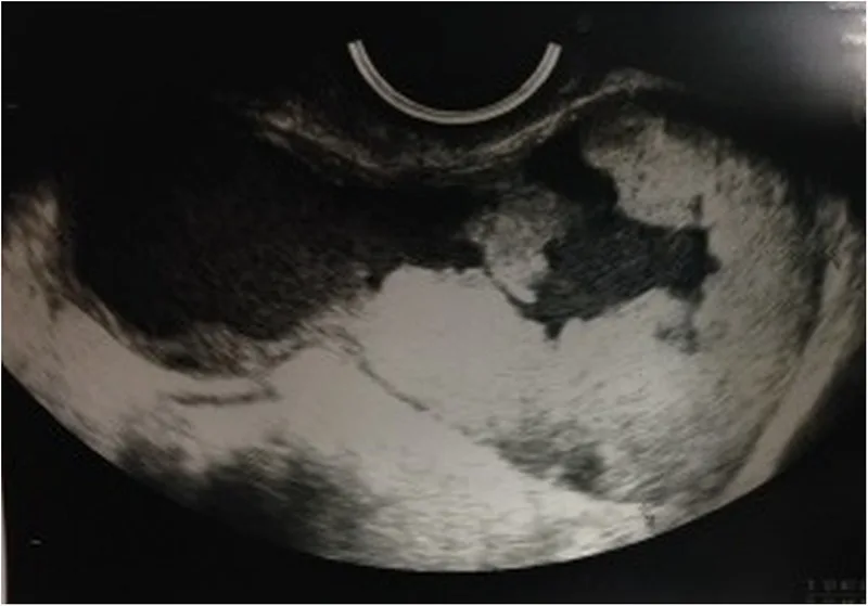 A patient, who was diagnosed with Ovarian Cancer